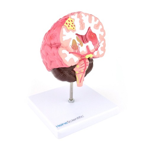 Model of the Vascular Diseases in the Brain